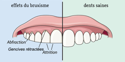 Explication du Bruxisme, Dentiste, Paris 19 eme, Bruxisme, Gouttière, Dr Giorno Hassan Elsie