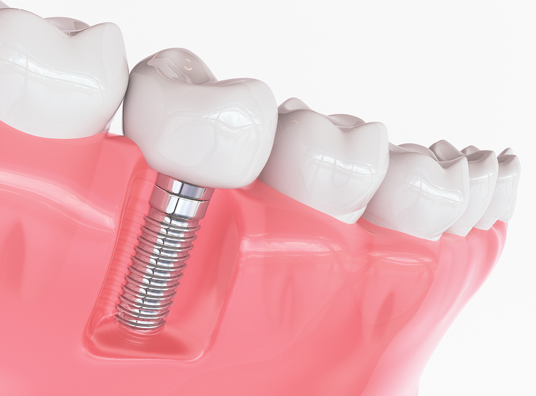 Pose d'implant, Dentiste, Dr Giorno Hassan Elsie, Paris 19 eme, Implant, Prothese sur implant